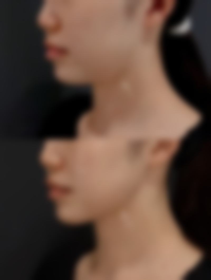 伊妍仕少女针型号维持时间