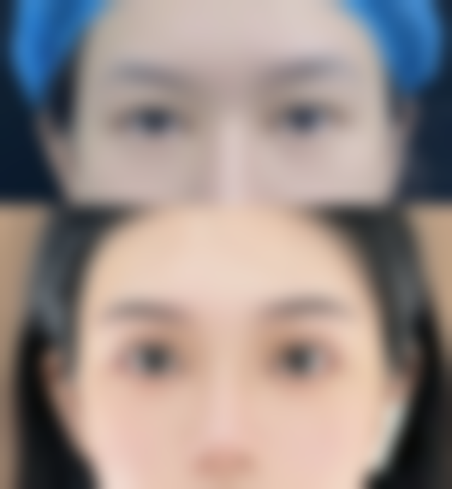 适合男生眼袋重的手术治疗方式有哪些？