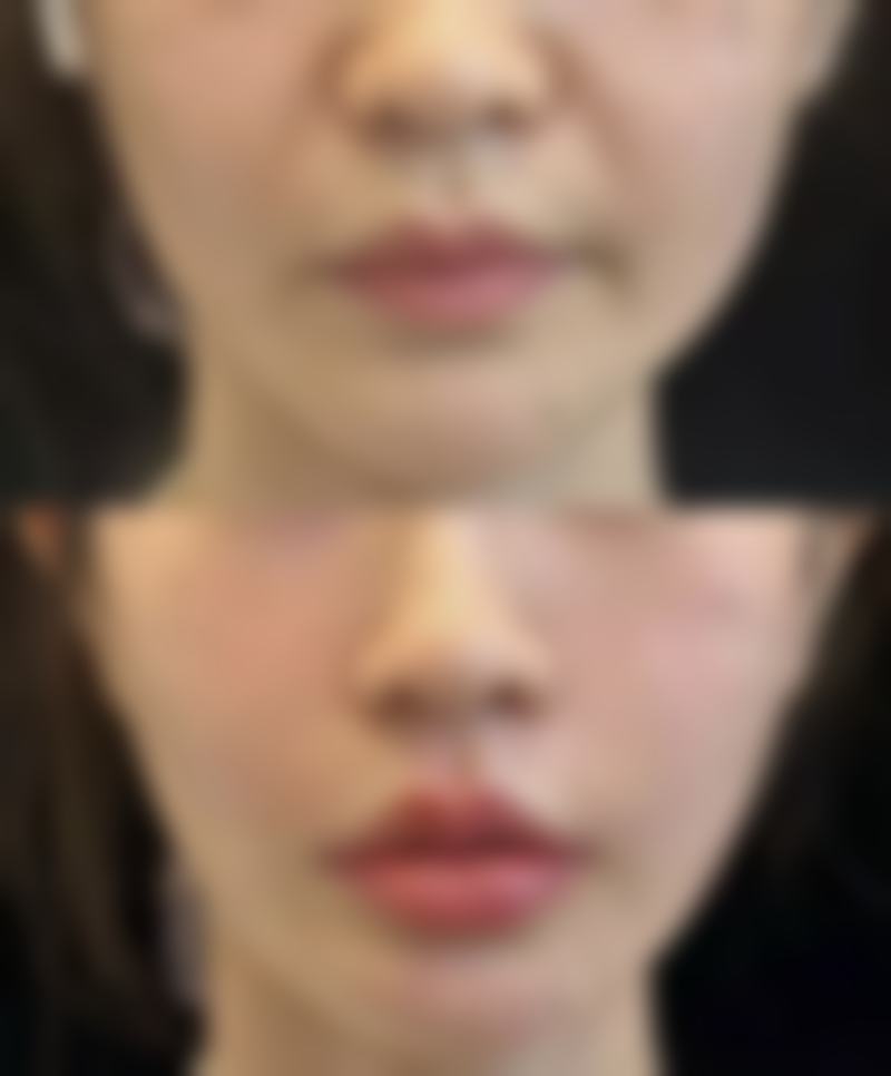 西安唇部整形排名第2名——西安画美整形医院