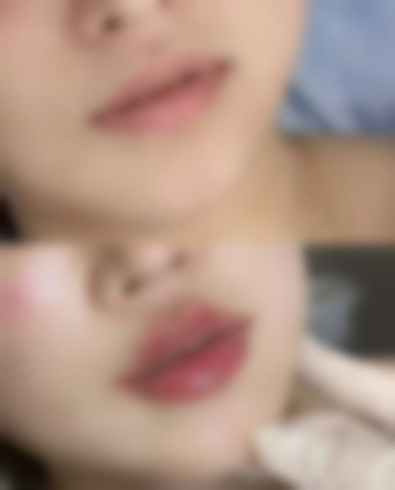 西安唇部整形排名第3名——西安米兰柏羽