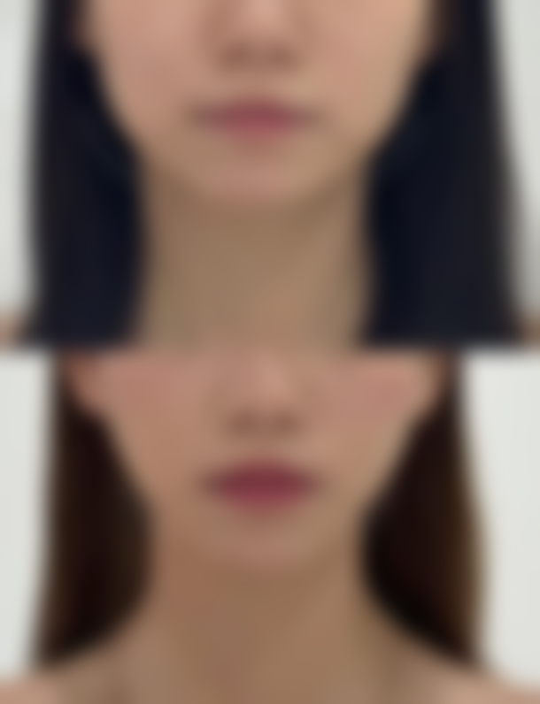 深圳玻尿酸填充额头价格的影响因素及怎么选择