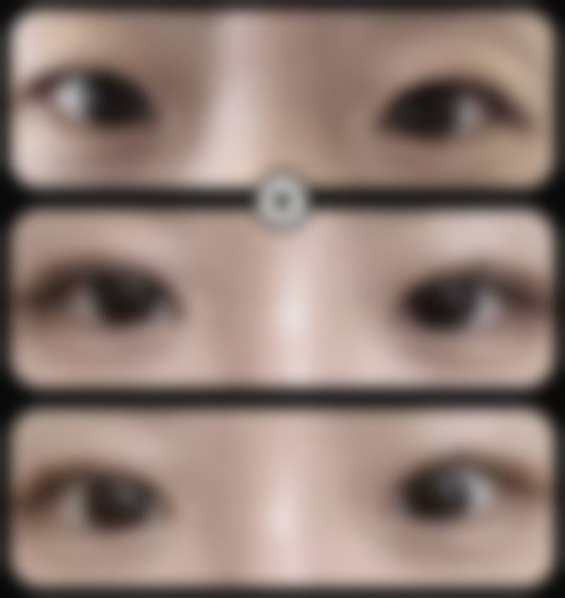 眼部项目价格透明：从初眼到修复，费用一目了然