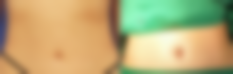 深圳不同医院玻尿酸填充额头价格