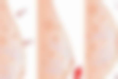 包膜挛缩是什么？通常在什么医学背景下被选择？