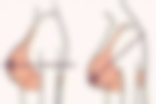 二、光子嫩肤&线提升提升2026价目表：价格为啥有浮动？