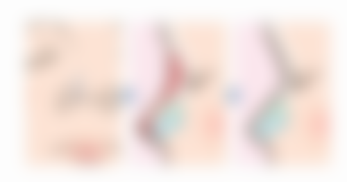 成都新华私密科邓娟娟:阴道紧缩术如何做到安心微痛?