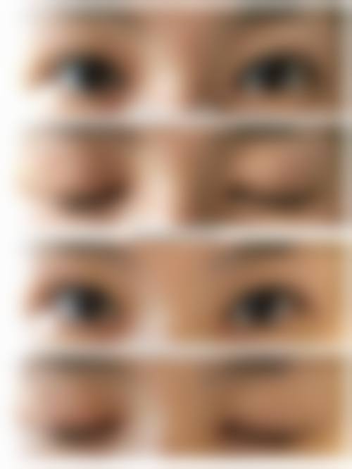 怎么判断我是否适合双眼皮提肌项目？