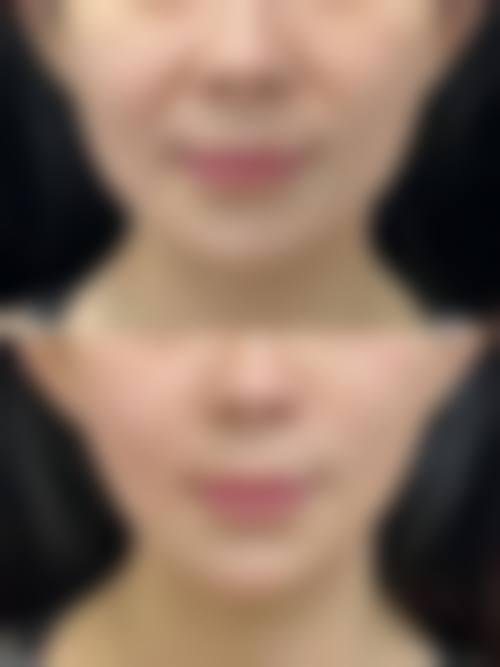 二、北京乔雅登玻尿酸一支大概多少钱？收费标准如何，能用医疗保险报销吗？——明细介绍