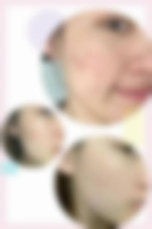 成都三等甲医院看痘痘