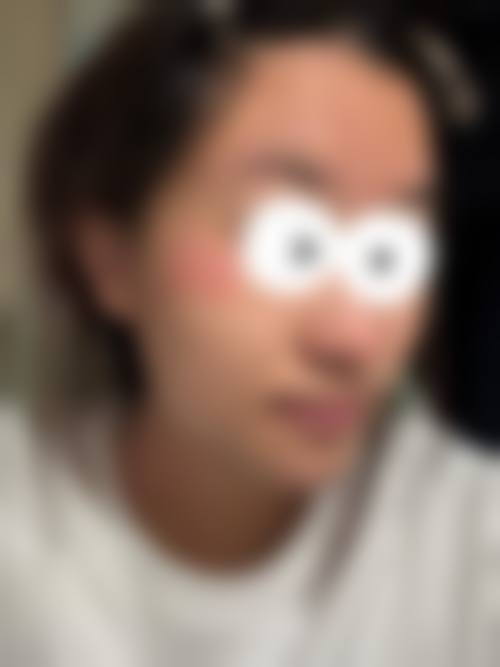 成都三等甲医院治痘痘多少钱