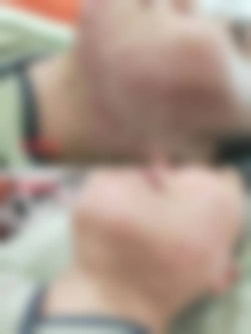 成都治痘痘去哪个医院好？哪家医院治痘痘好？告诉你！成都靠谱三甲医院治痘效果超厉害 华西/市三医院皮肤科稳当！