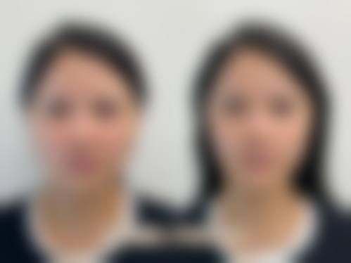 紫馨医美动态分层注射3800元起：值不值？用户真实反馈