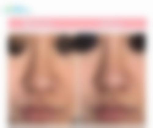 肋软骨隆鼻术后护理有哪些要点?关乎手术成效和后遗症!