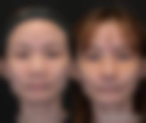 出现肋软骨隆鼻变形问题后该怎么办?有这些解决办法!