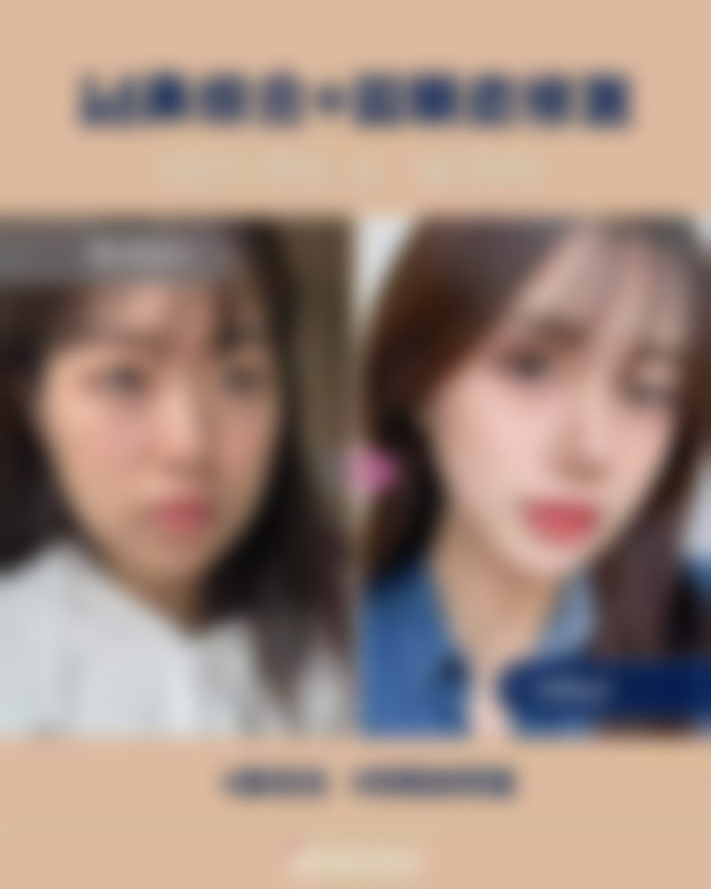 定点双眼皮手术多久能修复自然?