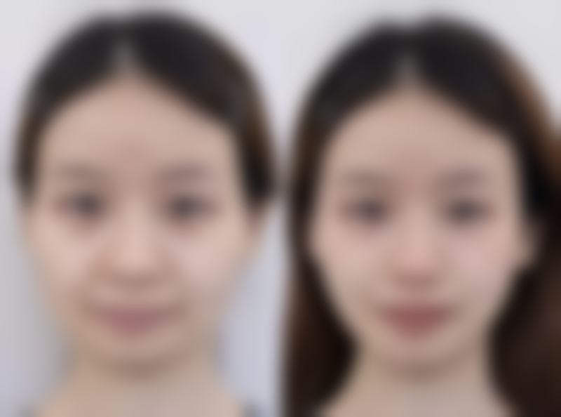 七、除了光子嫩肤和线提升，鞍钢总医院医学美容科还有哪些宝藏项目？