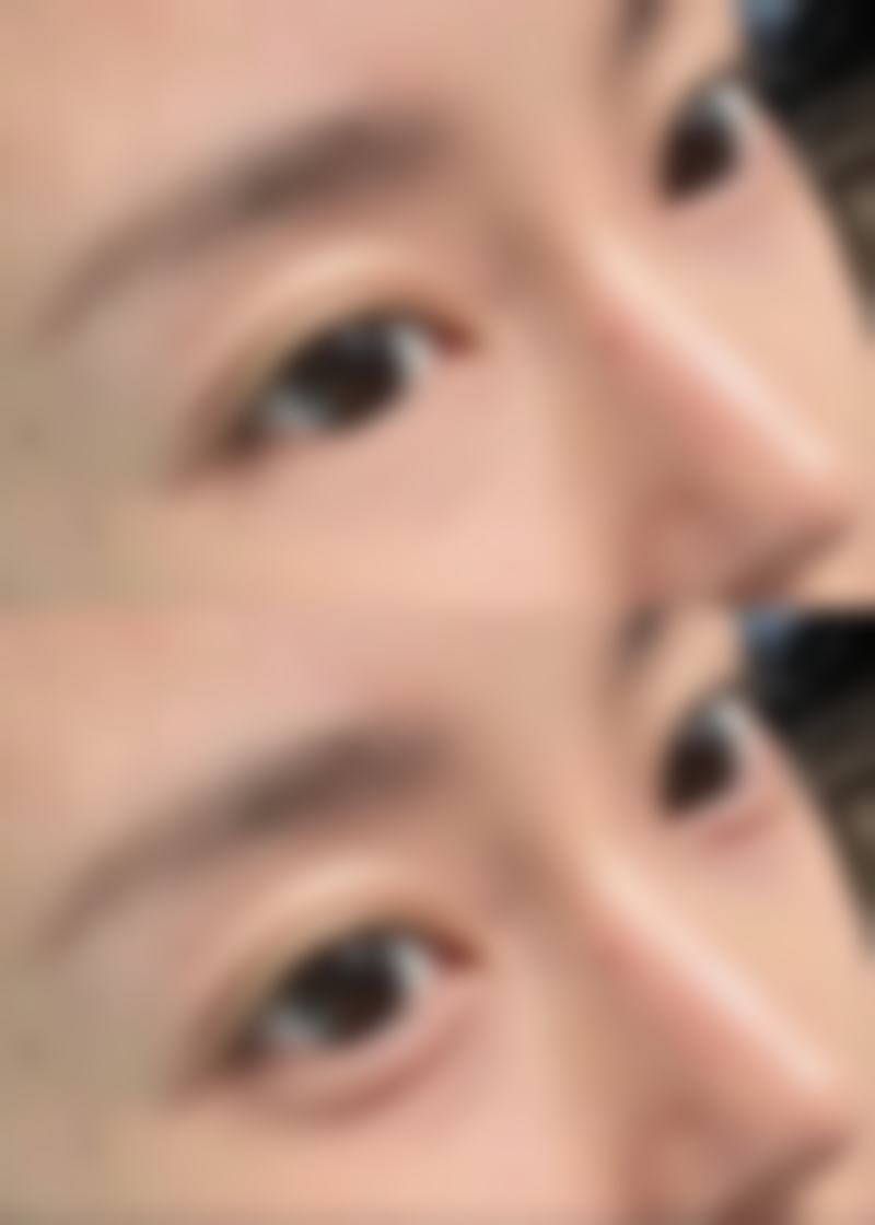 杭州抬头纹除皱针多少钱一针？价格几百到几千不等，性价比高的你知道咋选吗！2026肉毒素800元起/玻尿酸1500元起，联合丽格/艺星医院任选