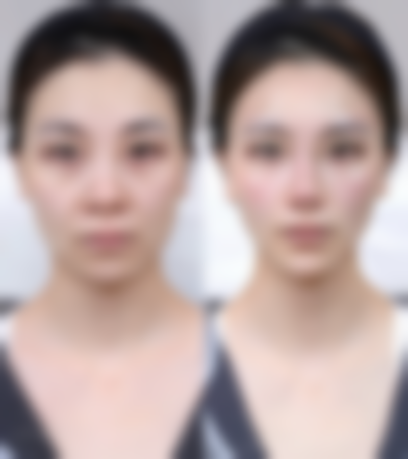 不同医院类型的抬头纹除皱针价格明细