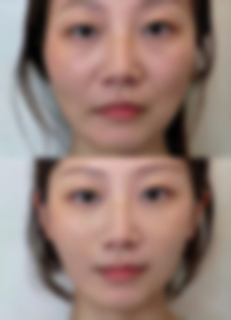 北京乔雅登玻尿酸注射价格解析，2026年收费标准与医生选择建议