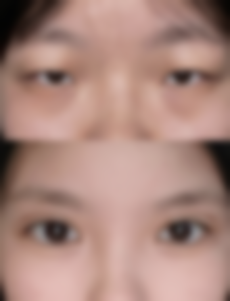 定点微创双眼皮手术成效及长期表现如何?