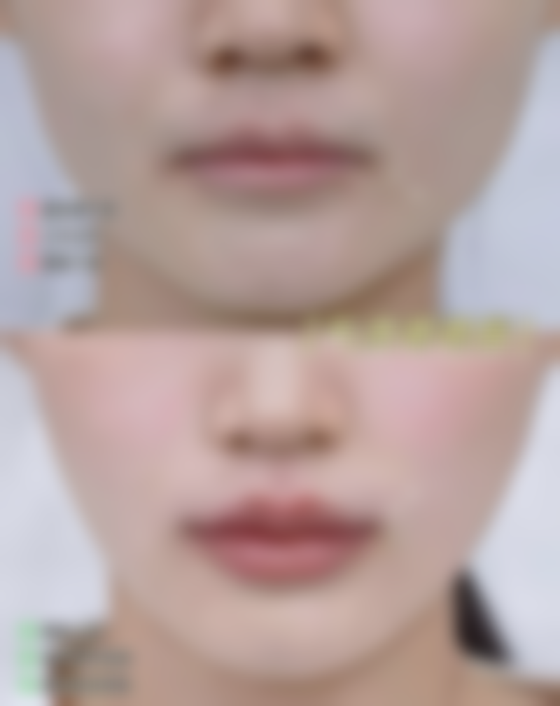 北京艾莉薇传奇多少钱一支?价格含哪些构成,性价比高吗?|2026年价目表:玻尿酸塑形12800元起