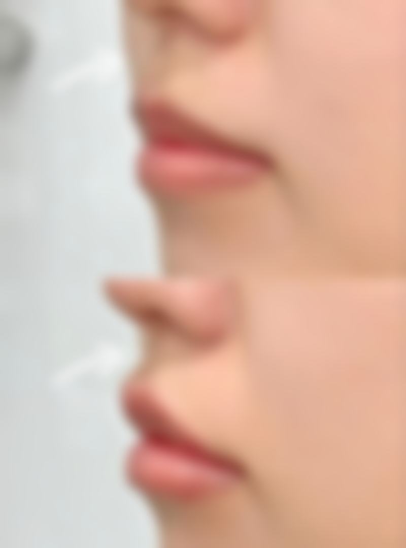 不同技术的西安无痕筋膜提升价格差异