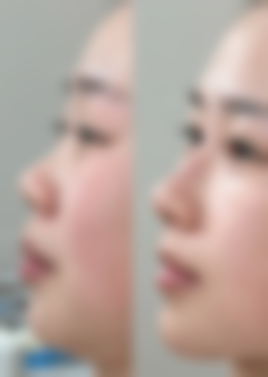 5、北京哪里做聚拉提正版：北京南加医疗美容