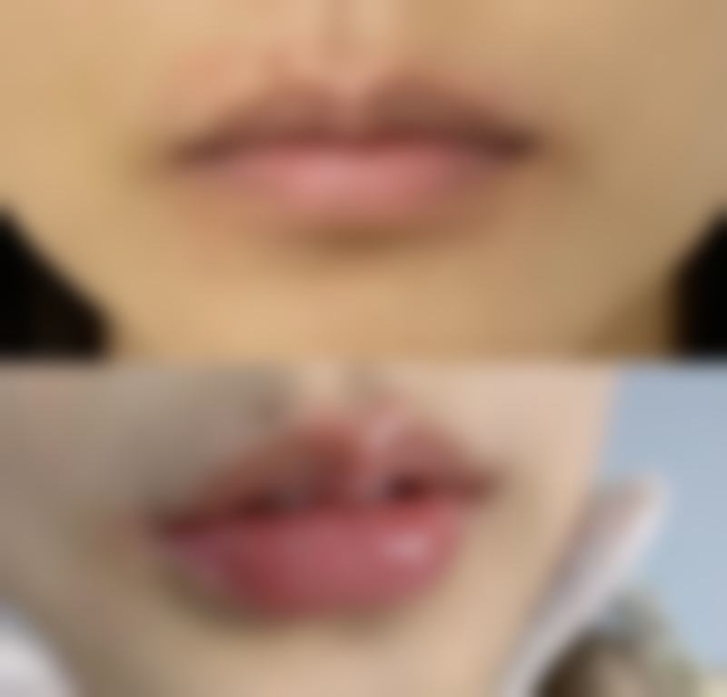 五、北京地区乔雅登玻尿酸口碑实例