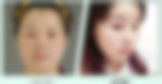 禾美嘉吸脂仪器项目价格表？性价比如何？