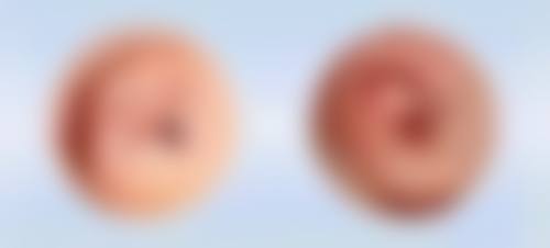 深圳畸形耳朵整形费用的影响因素及选择建议