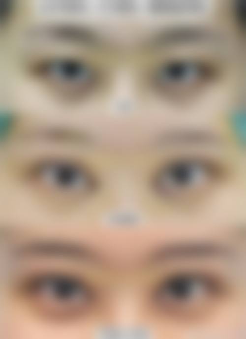 四、祛眼袋1936元起,到底有哪些方式?怎么选不踩坑?