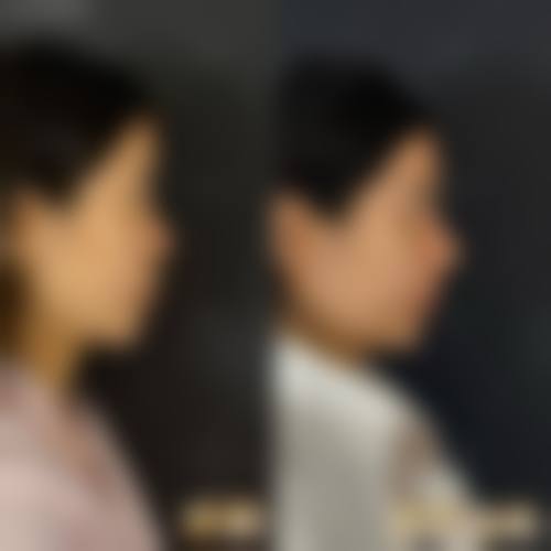 五、隆鼻4680元起,膨体、假体、肋骨鼻怎么选?