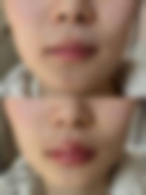 广州娇兰玻尿酸价格的影响因素及怎么选择