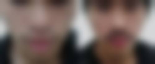 毛发种植是什么？通常在什么医学背景下被选择？