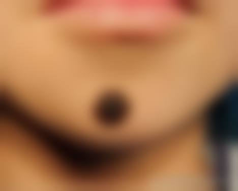 冻干粉对不同类型疤痕修复时间有何不同?