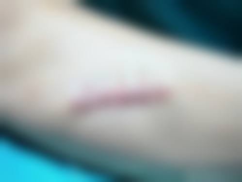 冻干粉疤痕修复的价格区间及费用差异来源