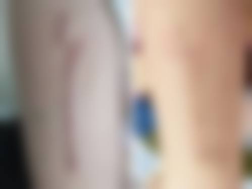 冻干粉疤痕修复治疗成效通常能维持多久?常见变化路径