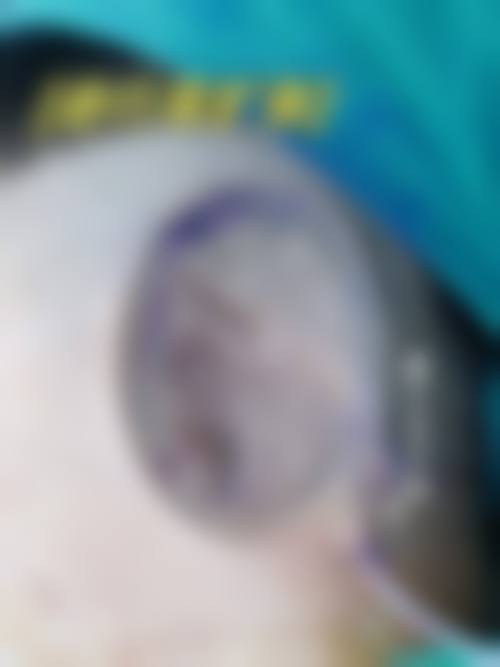 不同医院的深圳畸形耳朵整形价格情况