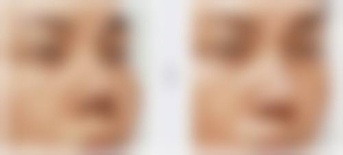 冷静总结：什么情况下，适合进入耳软骨隆鼻下一步评估