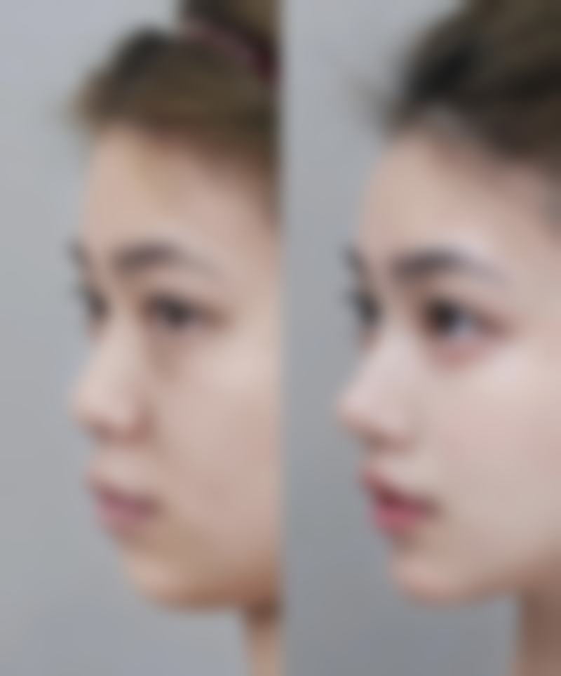 三、双眼皮找李高峰：他做的眼睛为什么自然又好看？