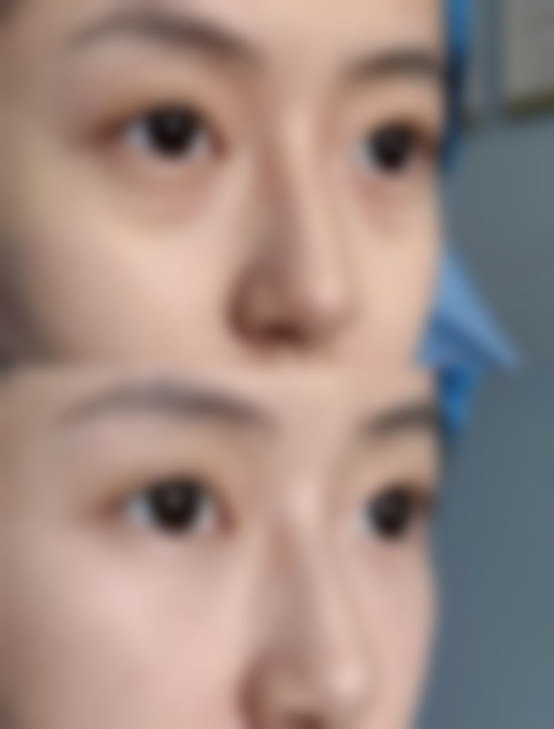 一单一双、大小眼,长大后会变成两个双眼皮吗?