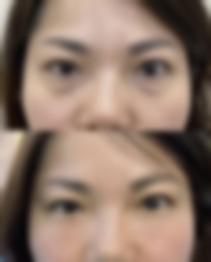 双眼皮手术有什么危害吗？有！可能引发感染、留疤、上睑下垂等问题需警惕！专家解析3大并发症及预防措施