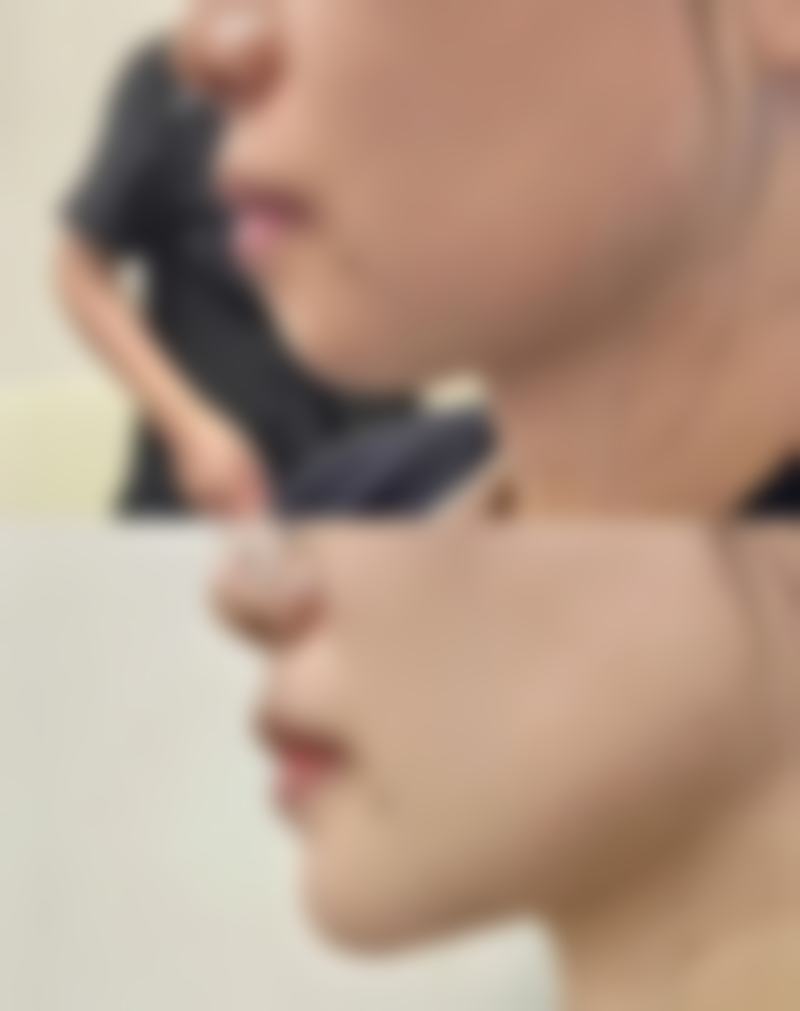 1. 郑州美莱医疗美容医院：郑州玻尿酸额头去皱医院哪家好？连锁品牌实力保护