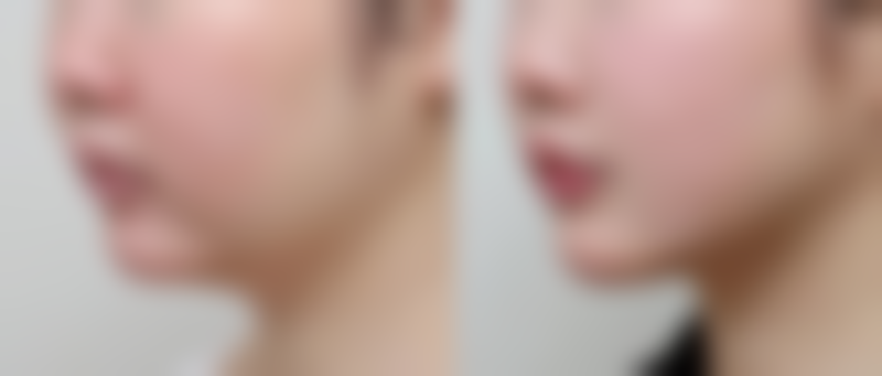 佛山吸脂手术费用价格的影响因素