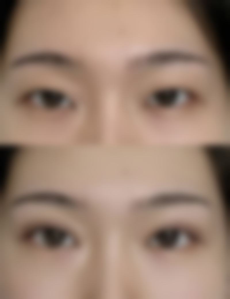 武汉爱尔眼科眼窝填充如何预约挂号?