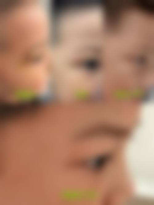 九、围绕疤痕成了一个硬疙瘩怎么消？可通过药物涂抹、压力疗法、激光治疗等方法有效消除！，临床中更常见的并发问题有哪些？