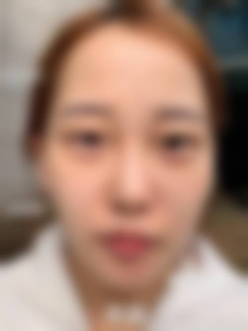 面部吸脂黄金微雕成效显现时间与修复过程有何关联?