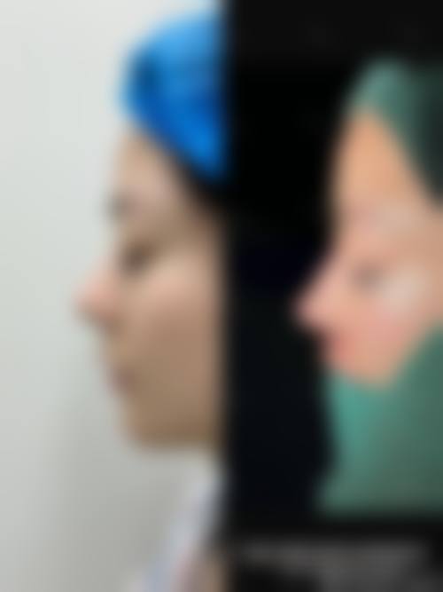 线提升隆鼻成功实例有哪些？真能看到自然神奇的成效吗？