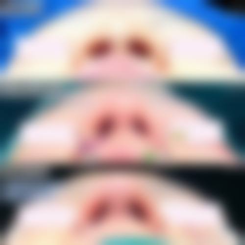 线提升隆鼻成效好不好？真的能在术后1 - 2周修复自然吗？