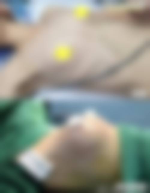 四、影响注射玻尿酸隆胸安心性的关键变量有哪些？